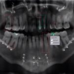 FDA批准登特。AI自动图表牙科软件